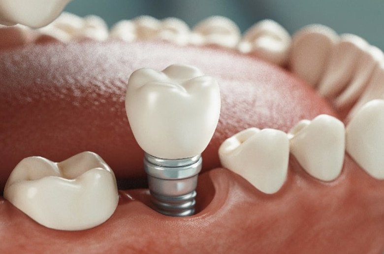 Doble implante dental