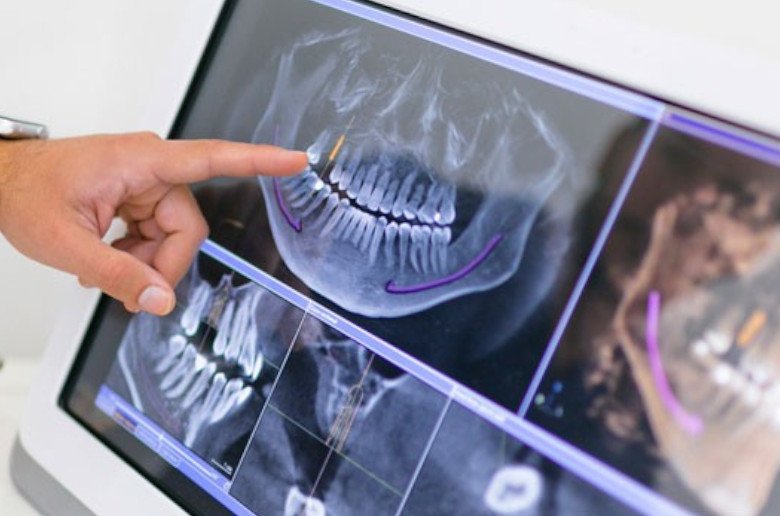 Implantes dental sin hueso